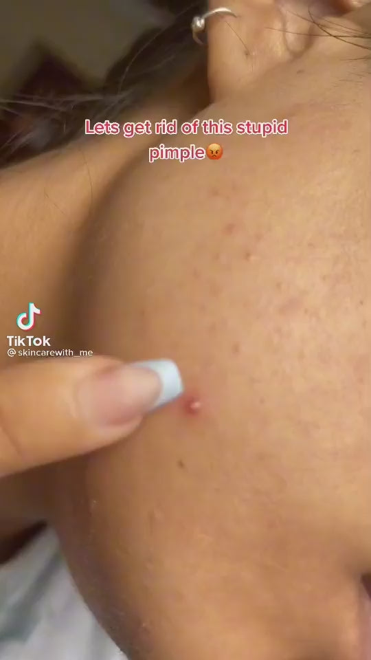 COSRX - Acne Pimple Master Patch - 24 Patchs